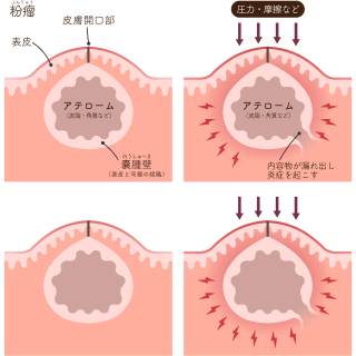 粉瘤(アテローム)の説明イラスト